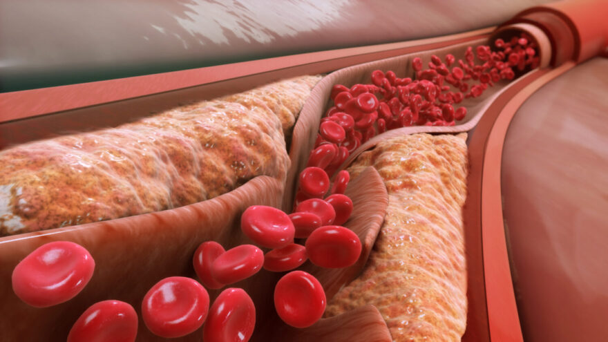 what is what is low-density lipoprotein (LDL)